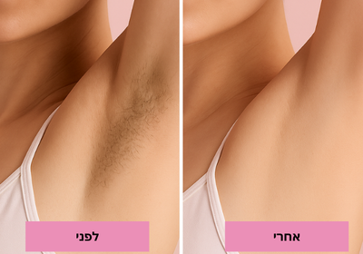 מכשיר הסרת שיער 4 ב־1
